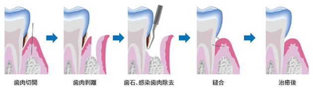 歯肉切開→歯肉剥離→歯石、感染歯肉除去→縫合→治療後