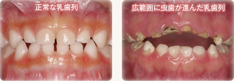 正常な乳歯列／広範囲に虫歯が進んだ乳歯列