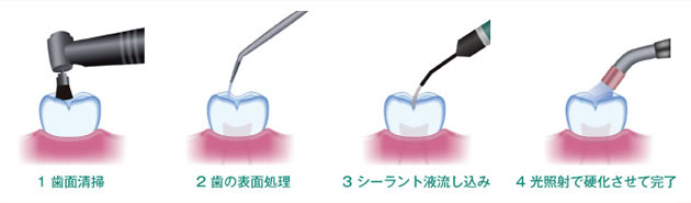 1 歯面清掃　2 歯の表面処理　3 シーラント流し込み　4 光照射で硬化させて完了