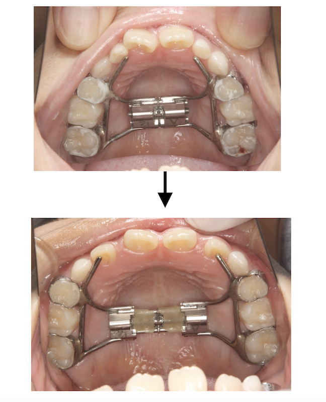 上顎 拡大 装置