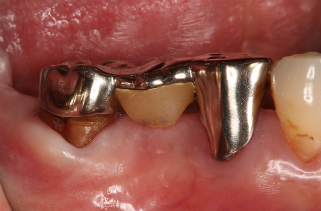 歯に詰める金属は安全ですか？｜歯の豆知識｜いちば歯科