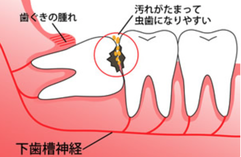 歯磨き の あと 歯 が 痛い