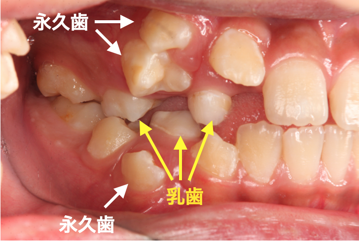 歯